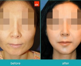 Phẫu thuật tạo đường nét trên khuôn mặt, Phẫu thuật gọt hàm,…