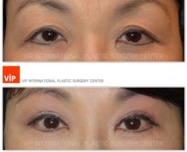 Phẫu thuật nâng chân mày
