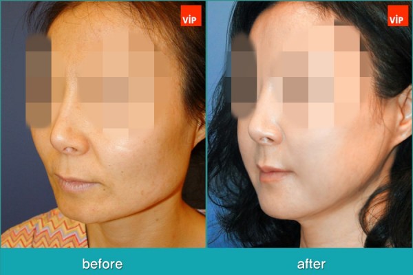 Facial Bone Surgery, Stem Cell Fat Graft - Phẫu thuật tạo đường nét trên khuôn mặt, Phẫu thuật gọt hàm, Phẫu thuật hạ gò má, Cấy mỡ