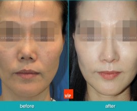 Nâng mũi bằng sụn sườn