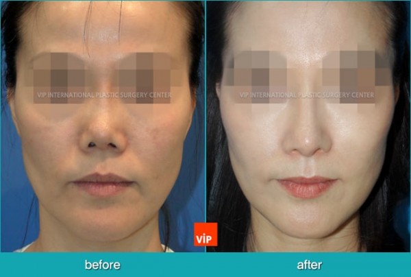 Nose Surgery - Nâng mũi bằng sụn sườn