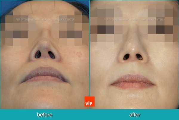 Nose Surgery - Nâng mũi bằng sụn sườn