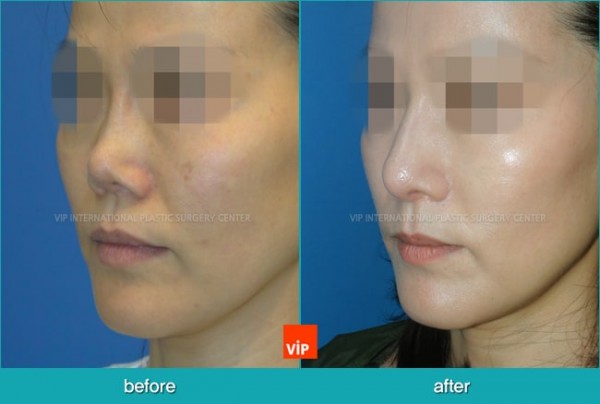 Nose Surgery - Nâng mũi bằng sụn sườn