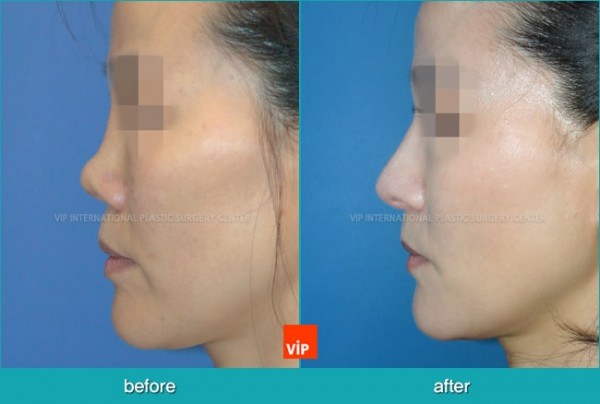 Nose Surgery - Nâng mũi bằng sụn sườn