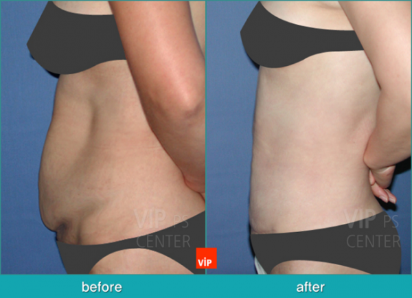 Body Contouring - Hút mỡ