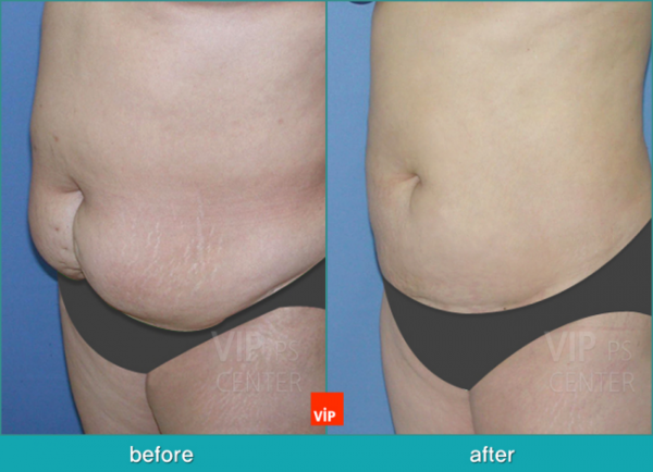 Body Contouring - Hút mỡ