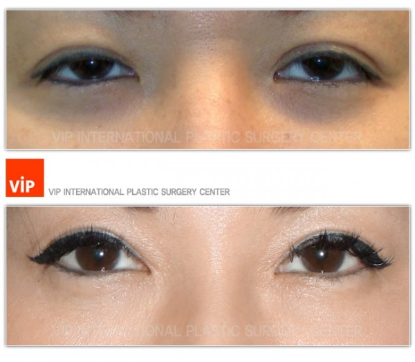 Eye Surgery - Phẫu thuật mắt hai mí, Sa mí mắt, Mở rộng khóe mắt trong