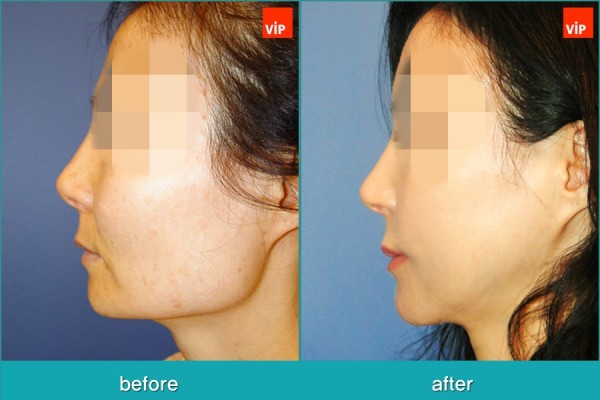Facial Bone Surgery, Stem Cell Fat Graft - Phẫu thuật tạo đường nét trên khuôn mặt, Phẫu thuật gọt hàm, Phẫu thuật hạ gò má, Cấy mỡ