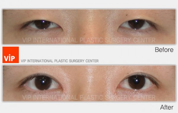 Eye Surgery - Phẫu thuật mắt hai mí