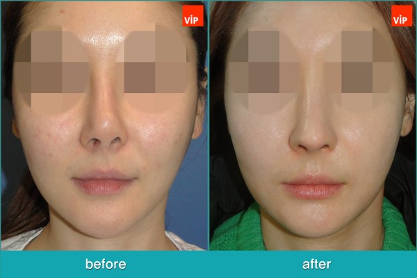 Nose Surgery - Nâng mũi bằng sụn sườn