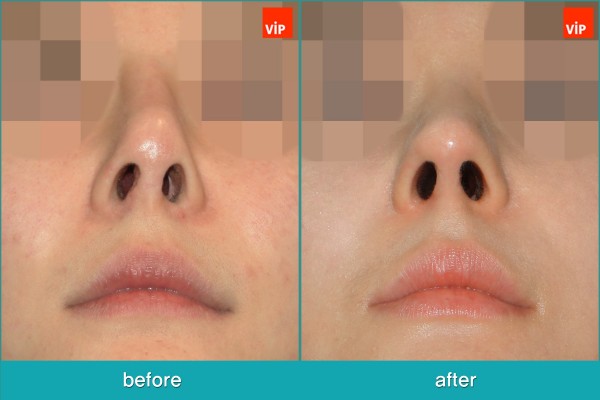 Nose Surgery - Nâng mũi bằng sụn sườn