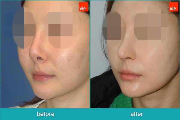Nose Surgery - Nâng mũi bằng sụn sườn