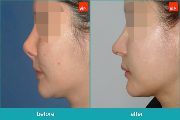 Nose Surgery - Nâng mũi bằng sụn sườn