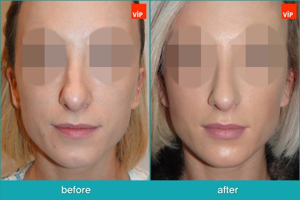 Nose Surgery - Chỉnh hình mũi lệch vách ngăn