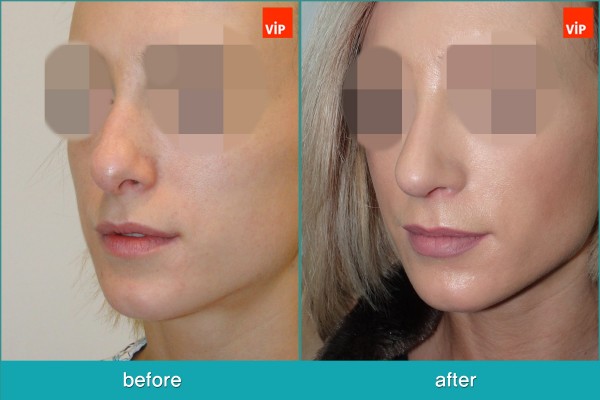 Nose Surgery - Chỉnh hình mũi lệch vách ngăn