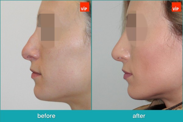 Nose Surgery - Chỉnh hình mũi lệch vách ngăn