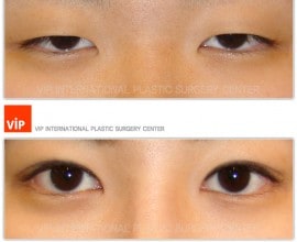 Phẫu thuật sa mí mắt