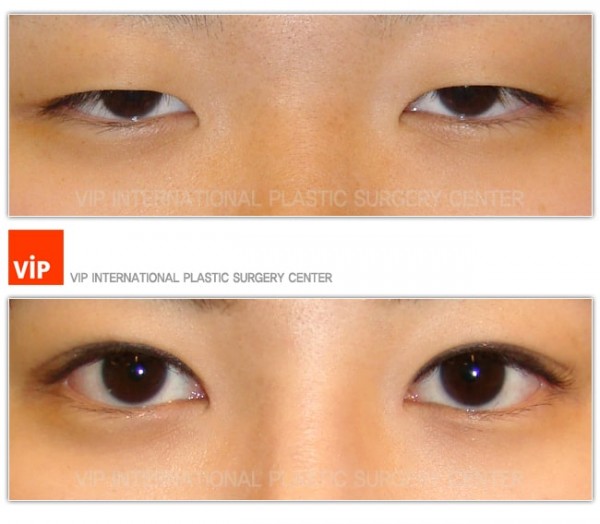 Eye Surgery - Phẫu thuật sa mí mắt