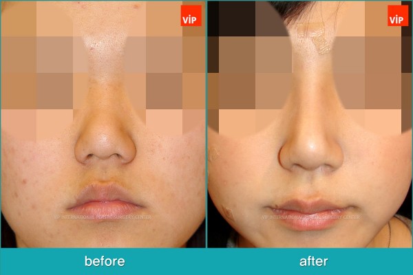 Nose Surgery - Phẫu thuật nâng mũi