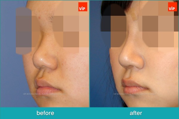 Nose Surgery - Phẫu thuật nâng mũi