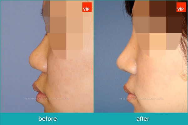 Nose Surgery - Phẫu thuật nâng mũi