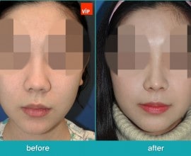 Chỉnh hình mũi lệch vách ngăn