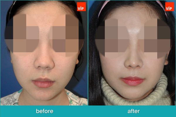 Nose Surgery - Chỉnh hình mũi lệch vách ngăn