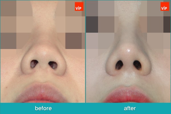 Nose Surgery - Chỉnh hình mũi lệch vách ngăn