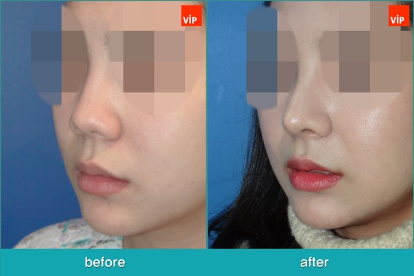 Nose Surgery - Chỉnh hình mũi lệch vách ngăn