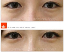Phẫu thuật mí mắt dưới