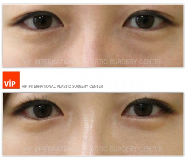 Eye Surgery - Phẫu thuật mí mắt dưới