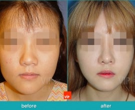 Nâng mũi bằng sụn vách ngăn