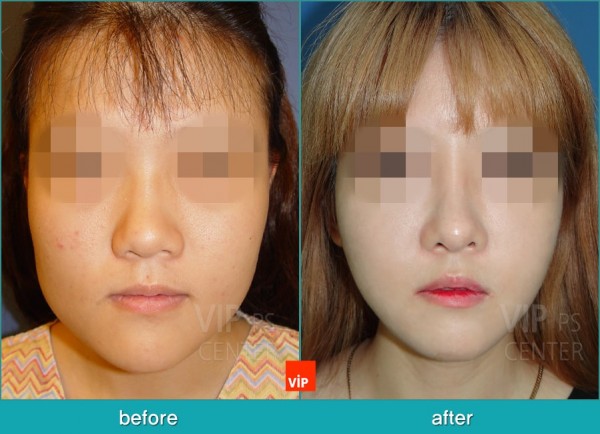 Nose Surgery - Nâng mũi bằng sụn vách ngăn