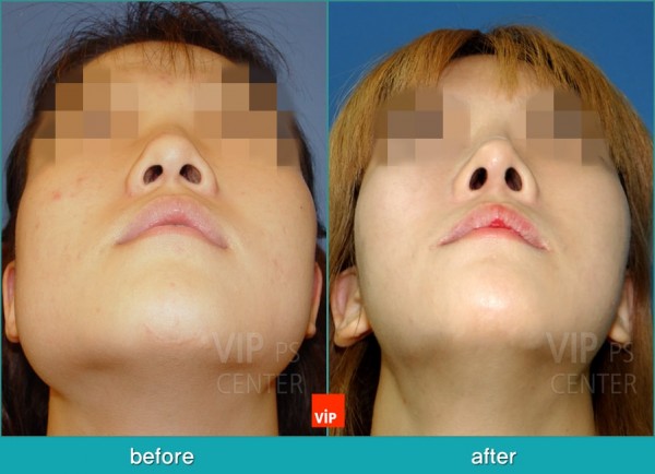 Nose Surgery - Nâng mũi bằng sụn vách ngăn