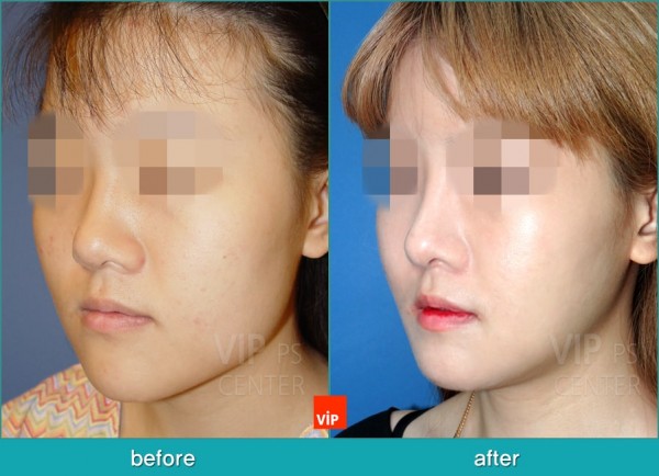 Nose Surgery - Nâng mũi bằng sụn vách ngăn