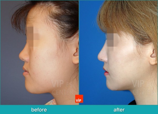 Nose Surgery - Nâng mũi bằng sụn vách ngăn