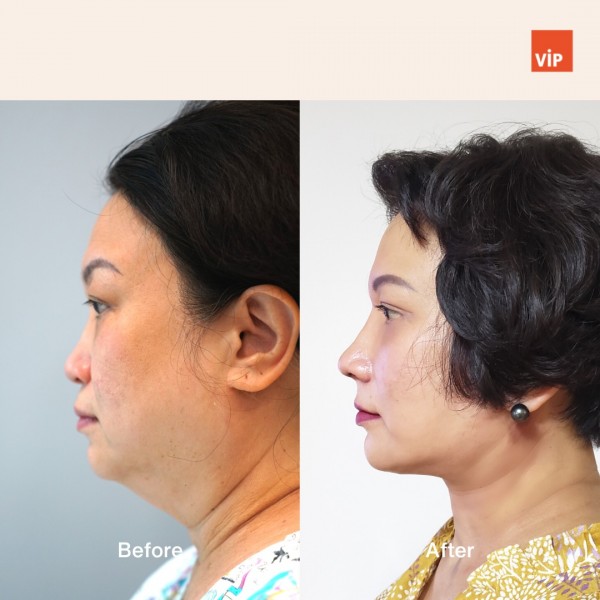 Nose Surgery, Face Lift - Rib Cartilage Rhinoplasty, Deep Plane Facelift, and Neck lift