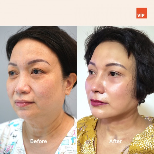 Nose Surgery, Face Lift - Rib Cartilage Rhinoplasty, Deep Plane Facelift, and Neck lift