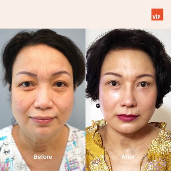 Nose Surgery, Face Lift - Rib Cartilage Rhinoplasty, Deep Plane Facelift, and Neck lift