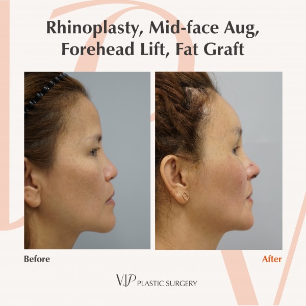 Nose Surgery, Face Lift, Stem Cell Fat Graft - Rhinoplasty, forehead lift, fat graft