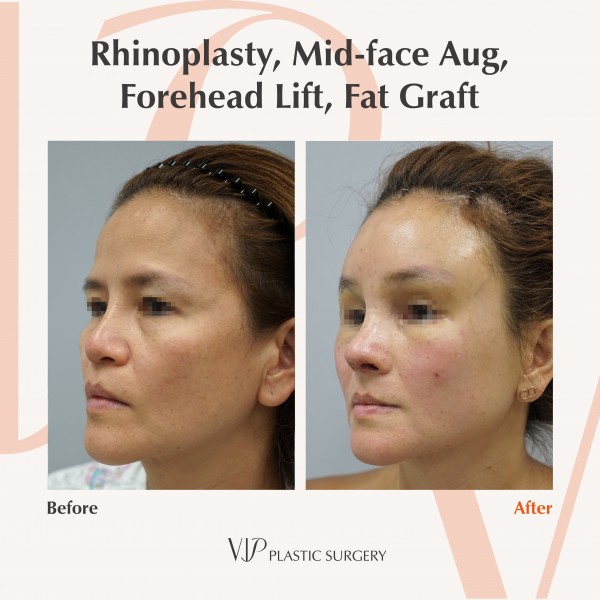 Nose Surgery, Face Lift, Stem Cell Fat Graft - Rhinoplasty, forehead lift, fat graft