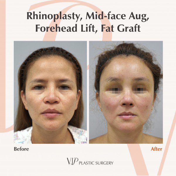 Nose Surgery, Face Lift, Stem Cell Fat Graft - Rhinoplasty, forehead lift, fat graft