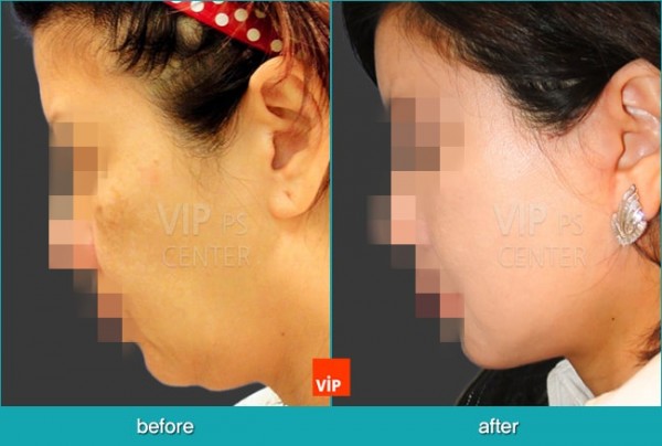 Face Lift - Căng da mặt/cổ High-SMAS