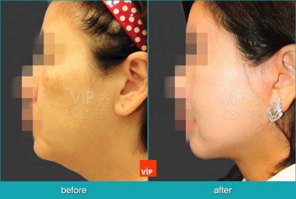 Face Lift - Căng da mặt/cổ High-SMAS