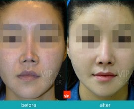 Nâng mũi bằng sụn sườn