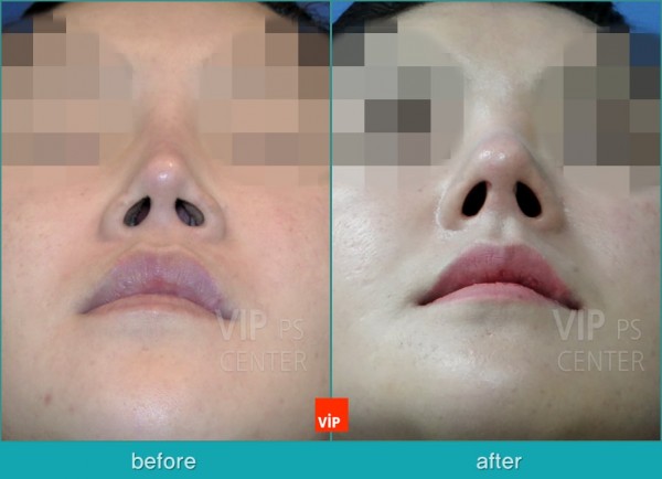Nose Surgery - Nâng mũi bằng sụn sườn
