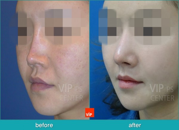 Nose Surgery - Nâng mũi bằng sụn sườn