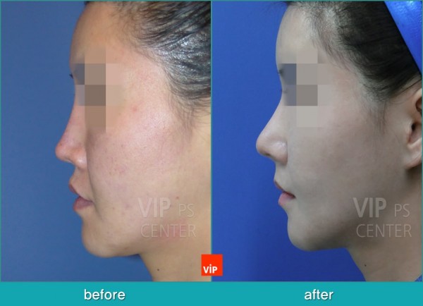 Nose Surgery - Nâng mũi bằng sụn sườn