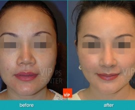 Nâng mũi bằng sụn sườn (Mũi ngắn)