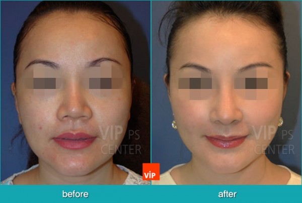 Nose Surgery - Nâng mũi bằng sụn sườn (Mũi ngắn)